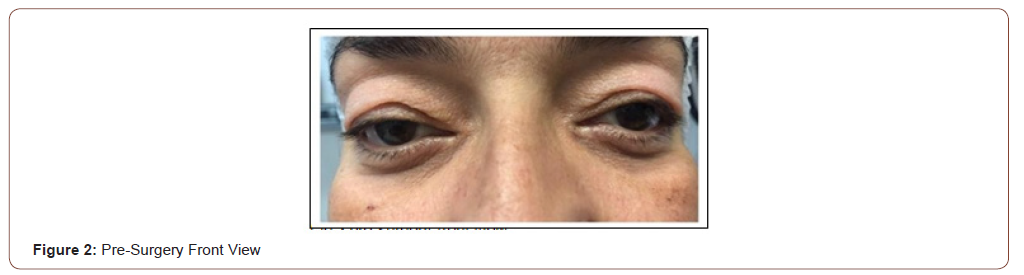 Click here to view Large Figure 2 irispublishers-openaccess-ophthalmology-vision-research