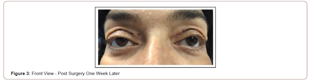 Click here to view Large Figure 3 irispublishers-openaccess-ophthalmology-vision-research