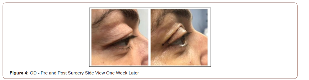 Click here to view Large Figure 4 irispublishers-openaccess-ophthalmology-vision-research