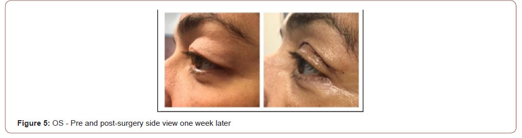 Click here to view Large Figure 5 irispublishers-openaccess-ophthalmology-vision-research